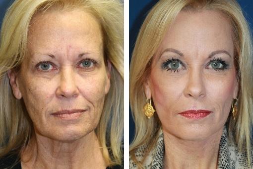 Man, 64, looks ’20 years younger’ after extreme face lift as he shares wild results