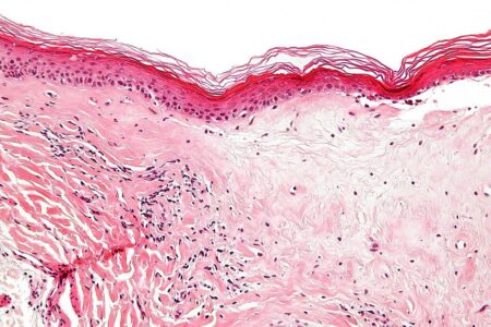 New online guide launched to support people affected by lichen sclerosus – University of Bristol