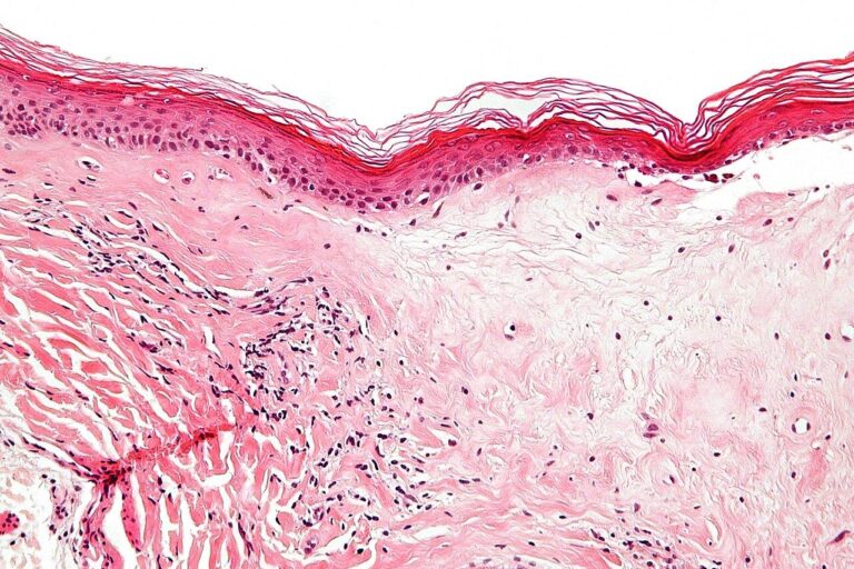 New online guide launched to support people affected by lichen sclerosus – University of Bristol