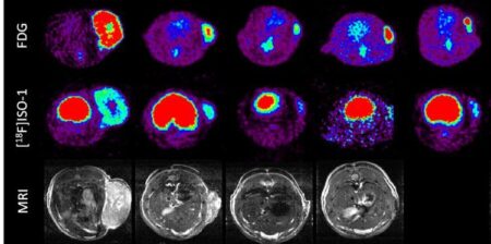 Leeds surgeons perform UK-first brain tumour operation – University of Leeds