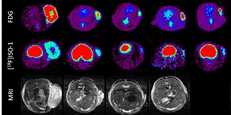 Leeds surgeons perform UK-first brain tumour operation – University of Leeds