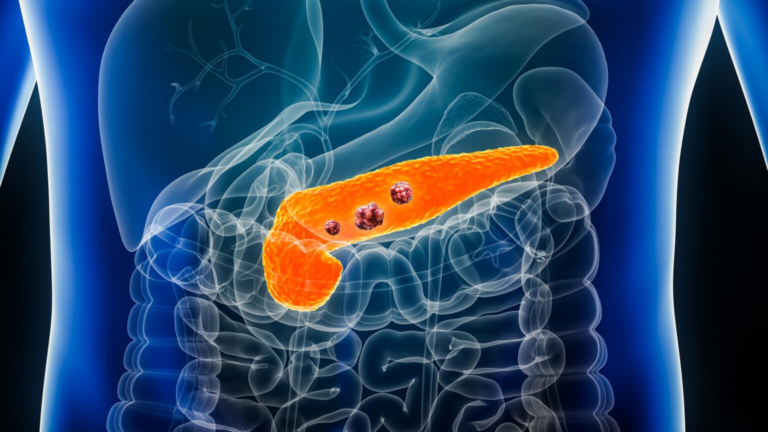 Birmingham opens first pancreatic cancer mRNA vaccine trial in Europe – University of Birmingham