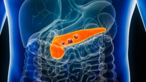 Birmingham opens first pancreatic cancer mRNA vaccine trial in Europe – University of Birmingham