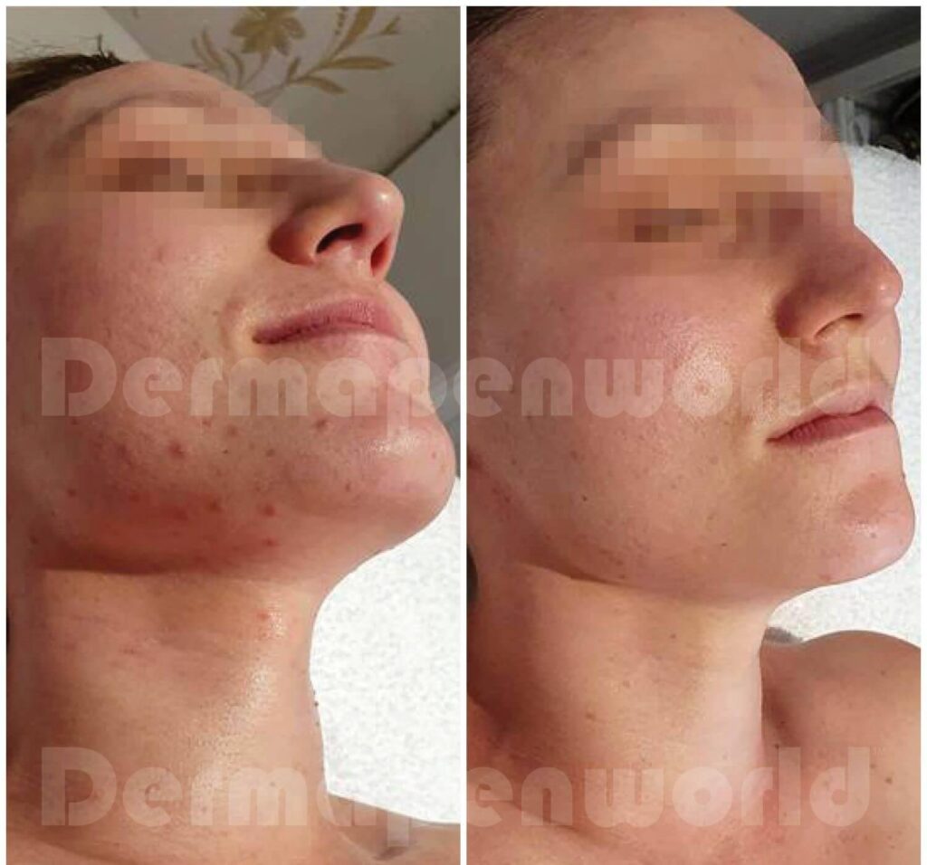 Vampire facial clients urged to get tested as ‘risk’ identified at Wolverhampton aesthetics clinic – Birmingham Live