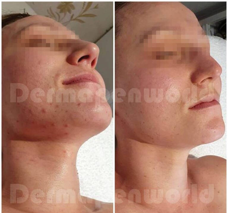 Vampire facial clients urged to get tested as ‘risk’ identified at Wolverhampton aesthetics clinic – Birmingham Live