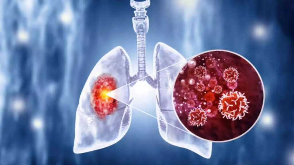 Cambridge researchers develop urine test for early detection of lung cancer – University of Cambridge