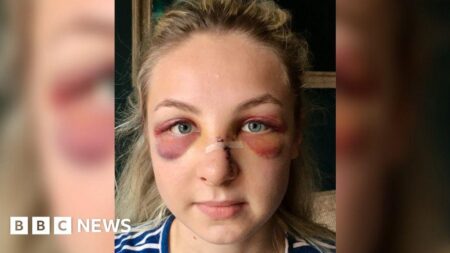 Attack in Leicester left officer with broken jaw and lost teeth – BBC