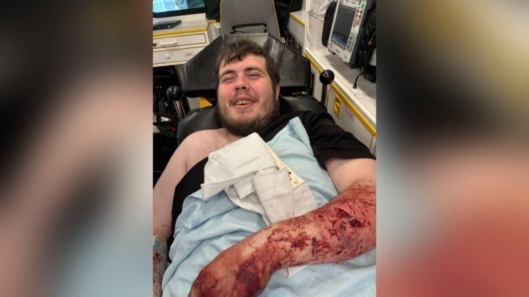 Stoke-on-Trent dog attack leaves woman with ‘serious’ injuries – Yahoo News UK