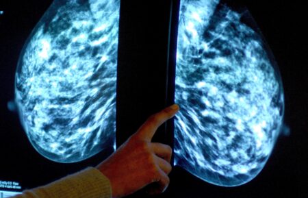 Enhanced breast cancer screening in the UK could detect an extra 3,500 cancers per year, trial shows – University of Cambridge
