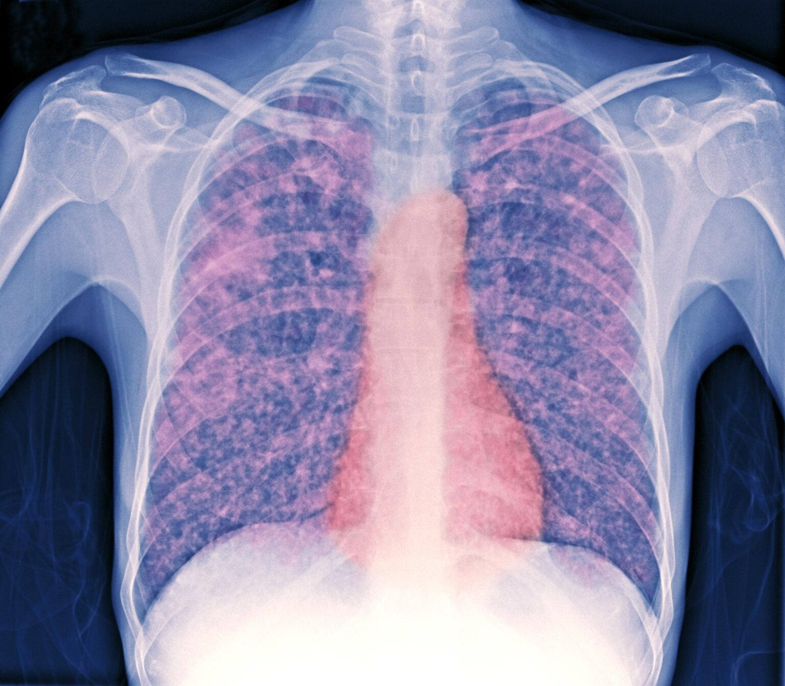 With tuberculosis cases on the rise across the UK, what have the figures been like in Milton Keynes? – Milton Keynes Citizen